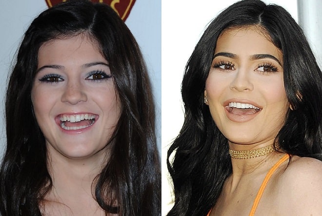 Kylie Jenner detailed veneer work